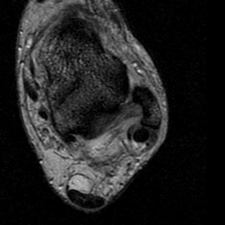 Peroneus brevis tendon split tear | Image | Radiopaedia.org