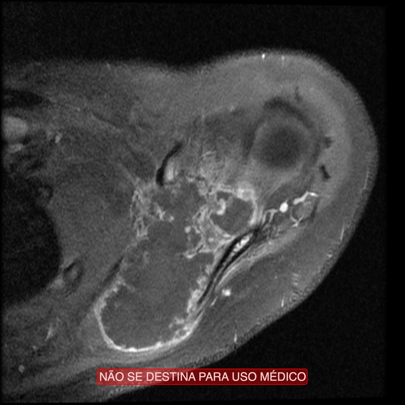 Chondrosarcoma of the scapula | Image | Radiopaedia.org