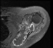 Chondrosarcoma | Radiology Reference Article | Radiopaedia.org