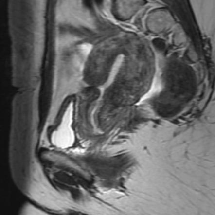 Cesarean section scar diverticulum | Radiology Reference Article ...