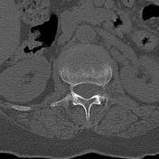 Viewing playlist: Coluna | Radiopaedia.org