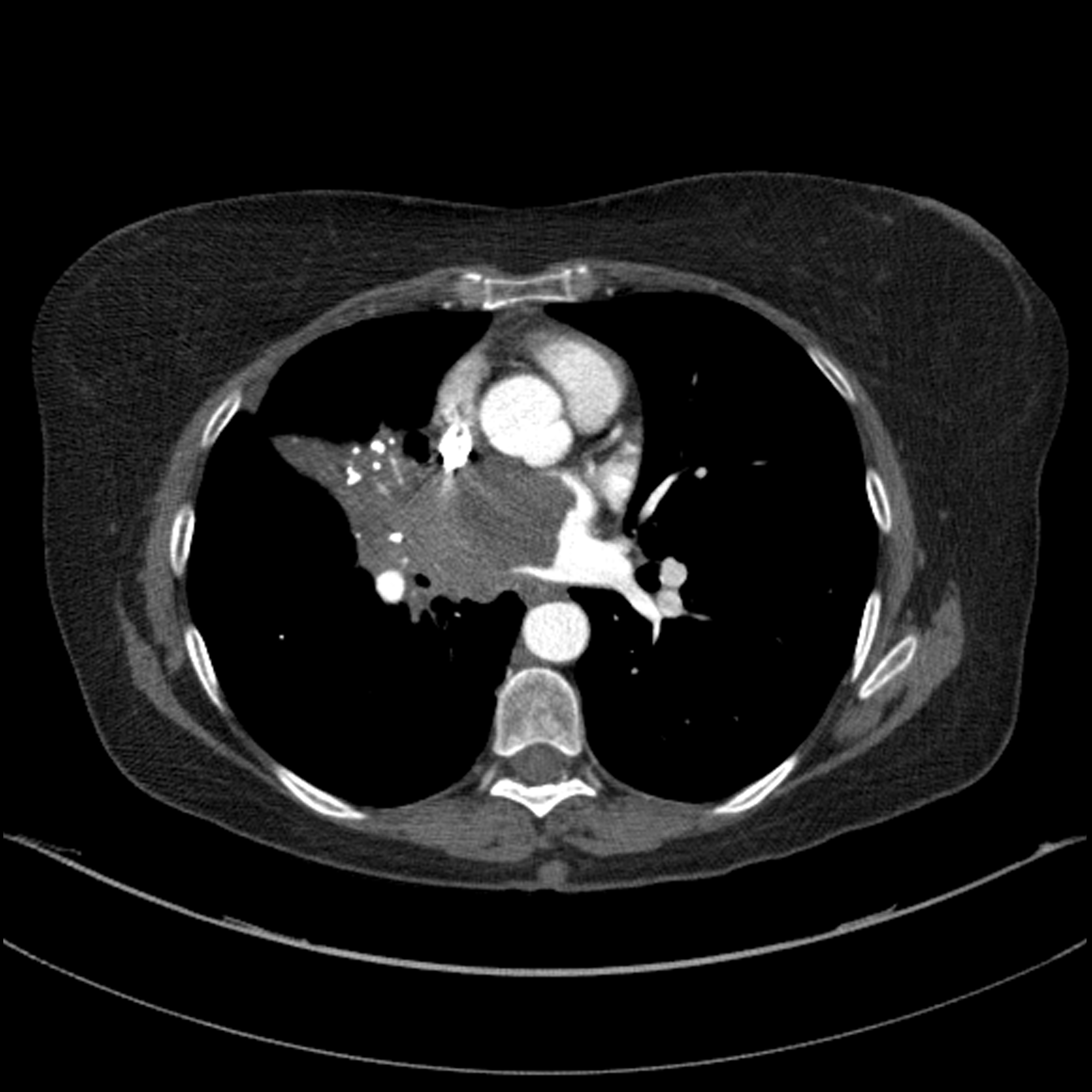 Adenocarcinoma of the lung | Image | Radiopaedia.org