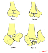 Riseborough and Radin classification of intercondylar fractures of the ...