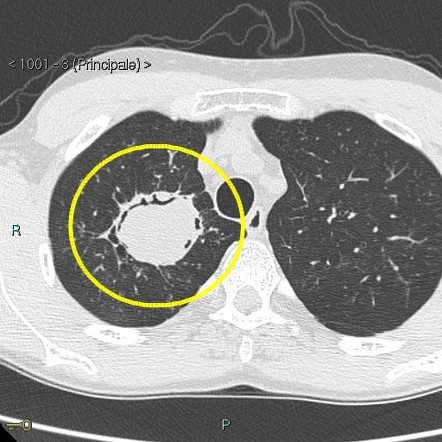 Aspergilloma | Radiology Case | Radiopaedia.org