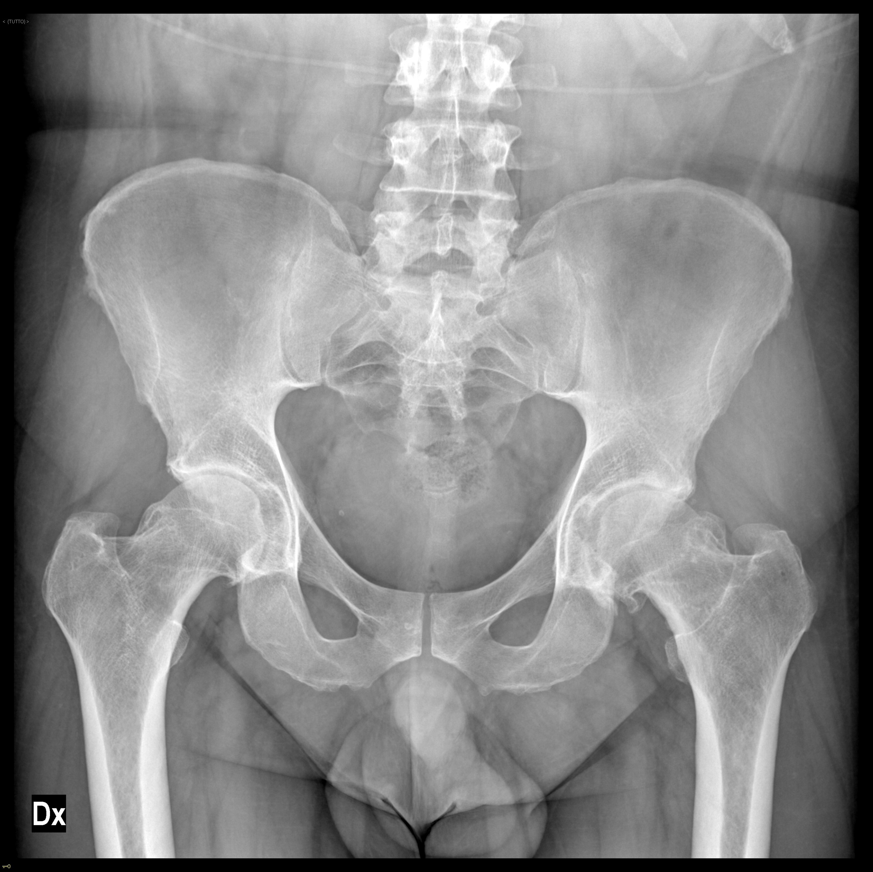 Femoro-acetabular impingement cam-type - with alpha angle measurements ...