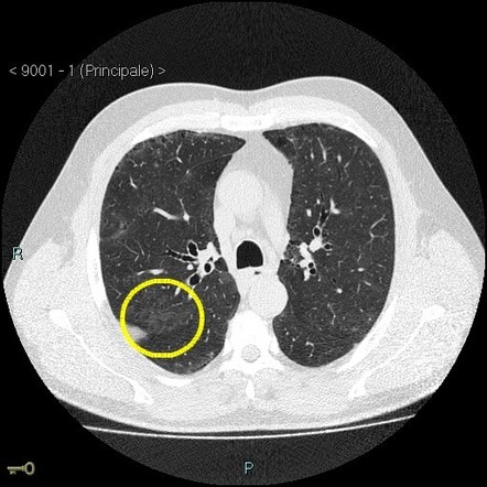 Respiratory Bronchiolitis Interstitial Lung Disease Rb Ild Radiology Case Radiopaedia Org