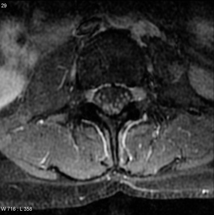 Leptomenigeal carcinomatosis - cauda equina | Image | Radiopaedia.org