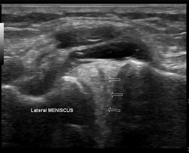 Meniscal Cyst Radiology Case Radiopaedia Org