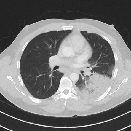 Lobar pneumonia | Radiology Reference Article | Radiopaedia.org