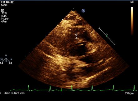 Incidental infundibular pulmonary stenosis and left sided superior vena ...