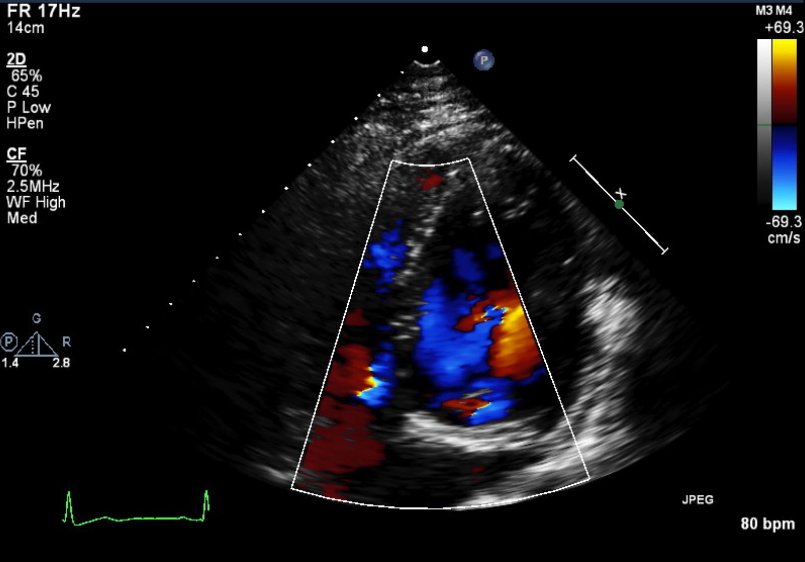 Incidental infundibular pulmonary stenosis and left sided superior vena ...