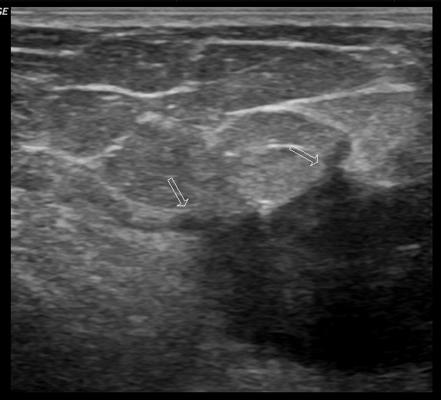 Malignant breast nodule | Image | Radiopaedia.org