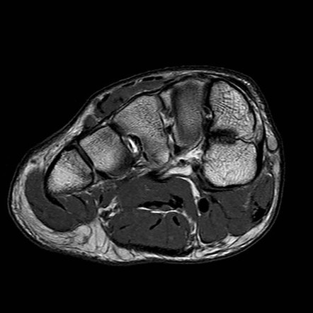 Bipartite medial cuneiform | Radiology Reference Article | Radiopaedia.org