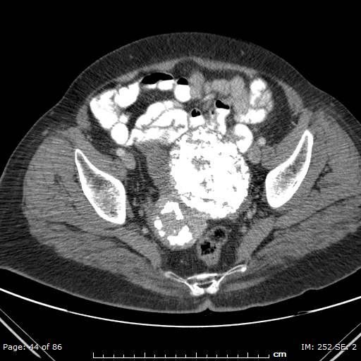 Uterine leiomyoma: calcified | Image | Radiopaedia.org