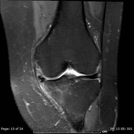 Parrot beak meniscal tear | Image | Radiopaedia.org