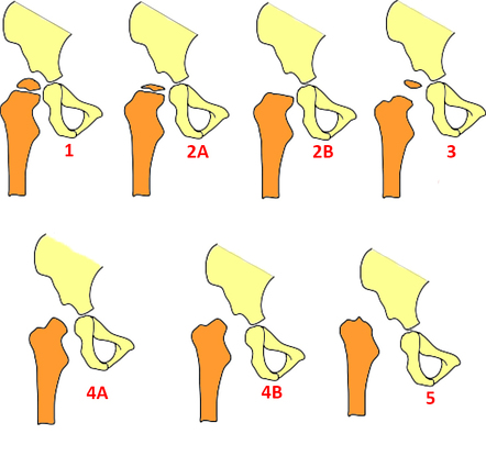 Hunka classification of pediatric septic arthritis of the hip ...