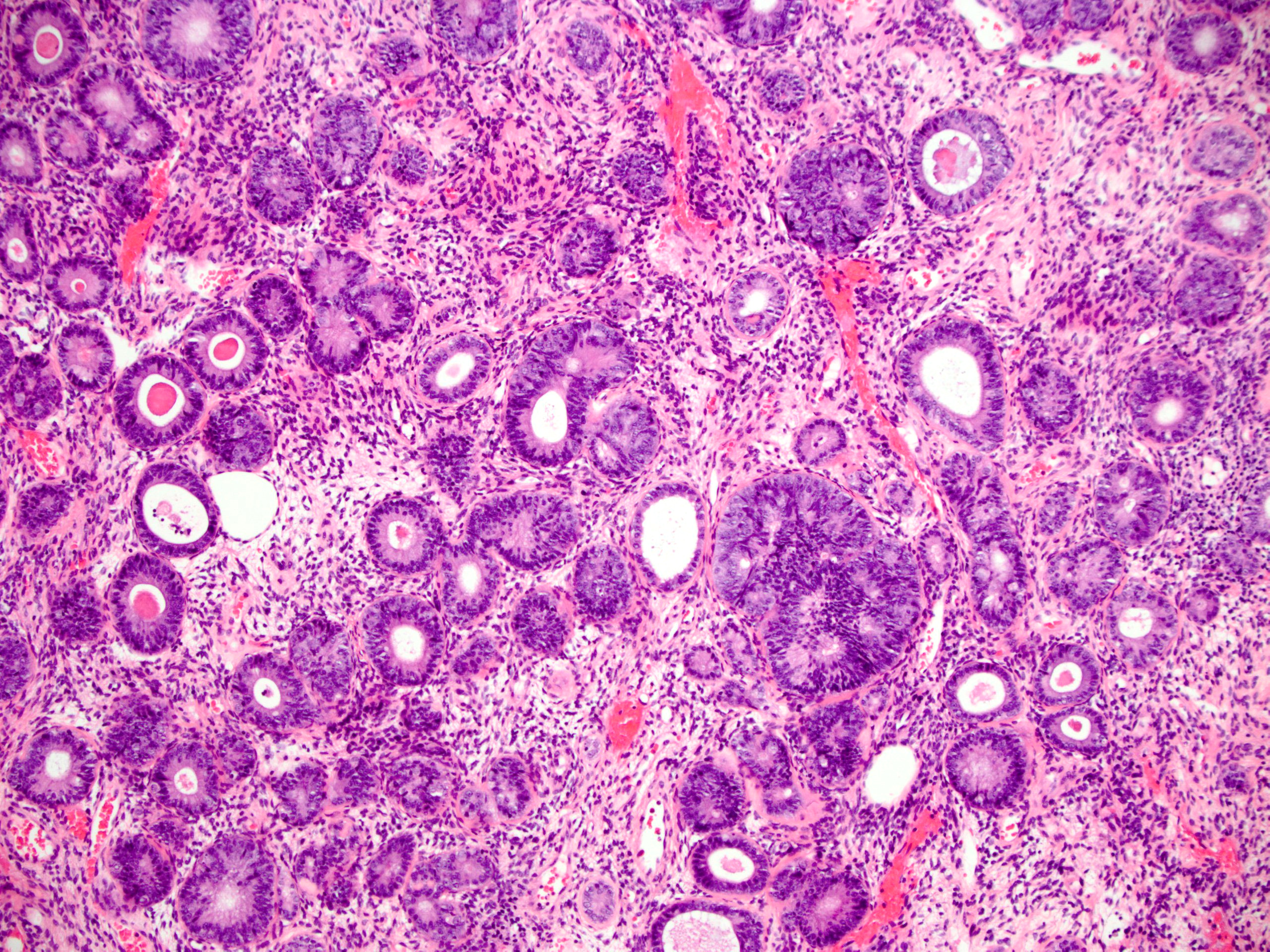 Atypical Cells In Endometrial Biopsy