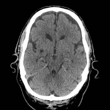 Prominent perivascular space | Radiology Case | Radiopaedia.org