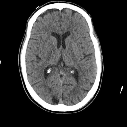 MCA infarct with CT perfusion and clot retrieval | Radiology Case ...