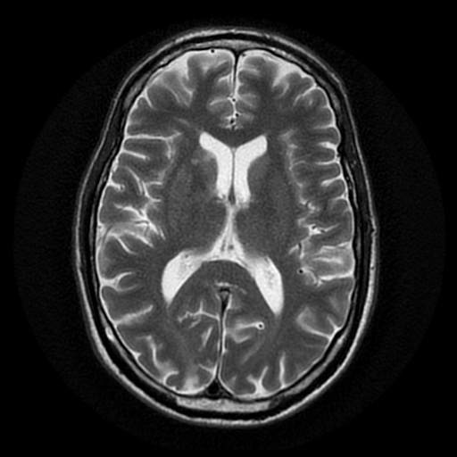 MCA infarct with CT perfusion and clot retrieval | Image | Radiopaedia.org