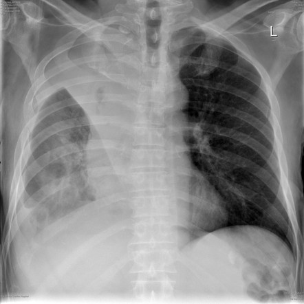 Right upper lobe collapse | Radiology Case | Radiopaedia.org