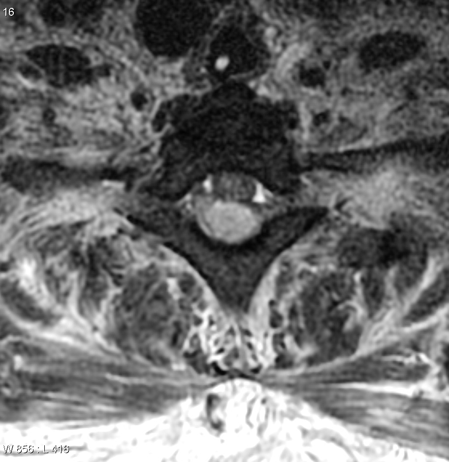 Discitis Osteomyelitis With Epidural Collection Image