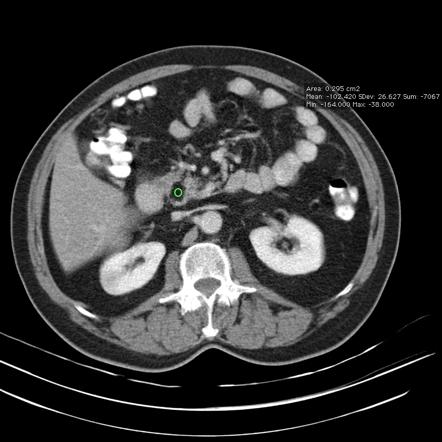 Lipoma | Radiology Reference Article | Radiopaedia.org