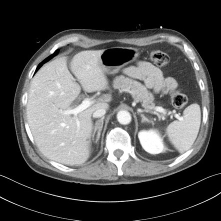 Adrenal hematoma | Radiology Case | Radiopaedia.org