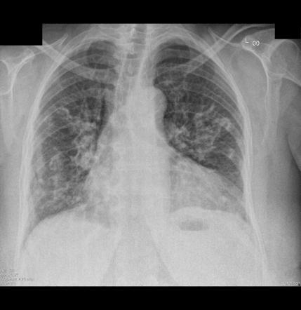 Pleural Thickening And Pleural Calcification Radiolog - vrogue.co