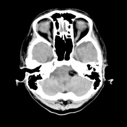 Cerebellopontine angle lipoma | Radiology Case | Radiopaedia.org