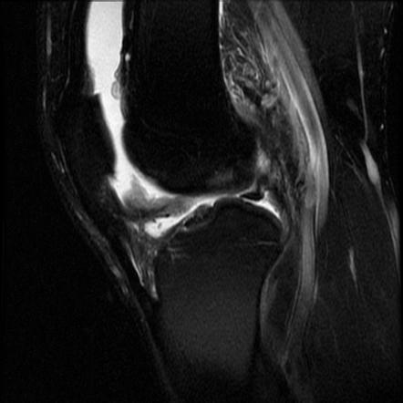 Infrapatellar plica injury | Image | Radiopaedia.org