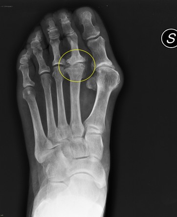 Freiberg infraction | Radiology Case | Radiopaedia.org