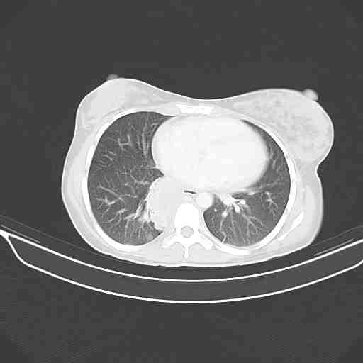 Pott disease | Image | Radiopaedia.org