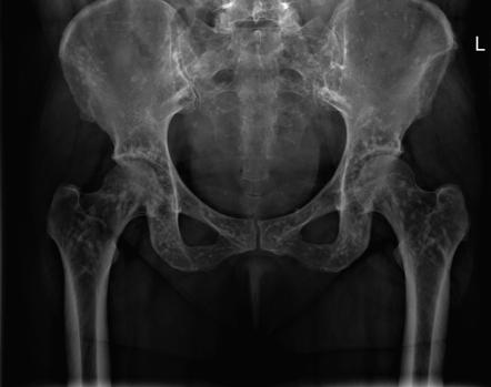 Osteopoikilosis | Radiology Case | Radiopaedia.org