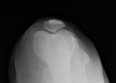 Synovial chondromatosis of knee | Image | Radiopaedia.org