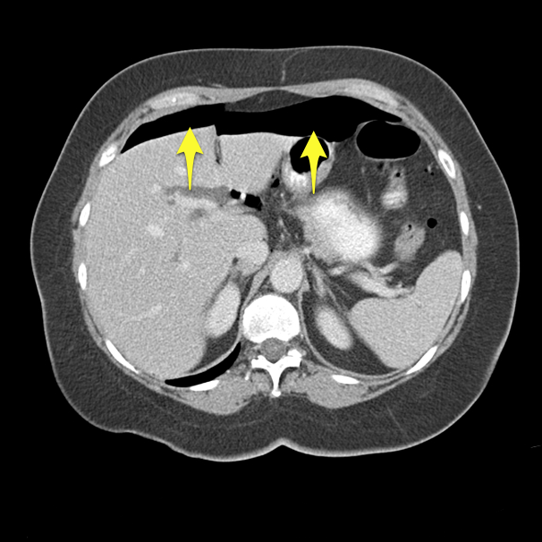 Sigmoid Diverticulitis - Perforated 