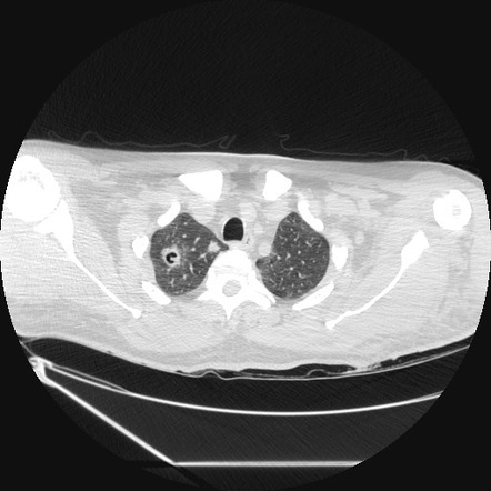 Pulmonary cryptococcosis | Radiology Case | Radiopaedia.org