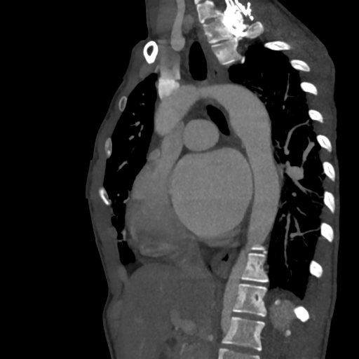 Patent Ductus Arteriosus | Radiology Case | Radiopaedia.org