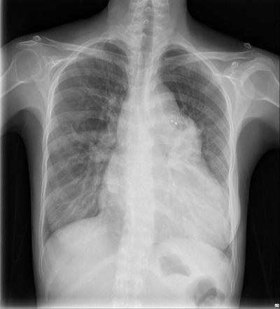 Patent ductus arteriosus | Radiology Case | Radiopaedia.org