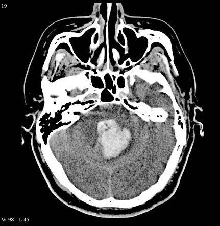 Cerebellar hemorrhage | Radiology Case | Radiopaedia.org