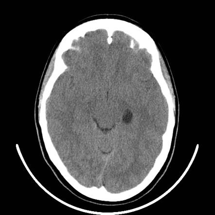 Choroidal fissure cyst | Radiology Reference Article | Radiopaedia.org