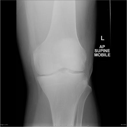 Patellar Fracture Radiology Reference Article Radiopaedia Org