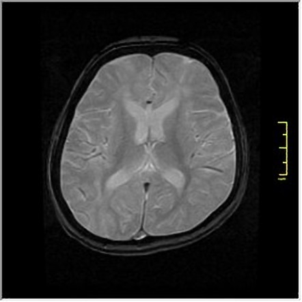 Subacute Sclerosing Panencephalitis | Image | Radiopaedia.org