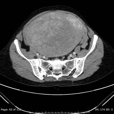 Uterine leiomyoma: large | Radiology Case | Radiopaedia.org