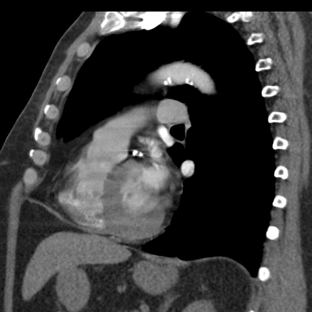 Lipomatous Hypertrophy Of The Interatrial Septum With Partial Svc