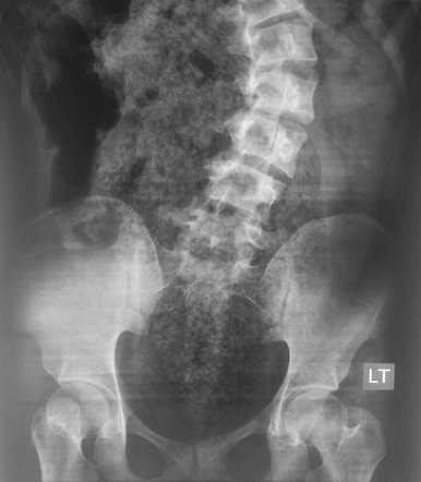 Fecal impaction, Radiology Reference Article