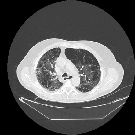 Emphysema Radiology