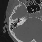 Radiopaedia - Drawing Middle ear ossicles: malleus, incus and