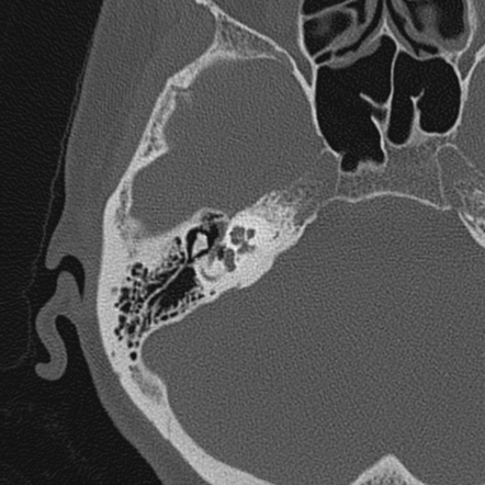 High-resolution CT | Radiology Reference Article | Radiopaedia.org