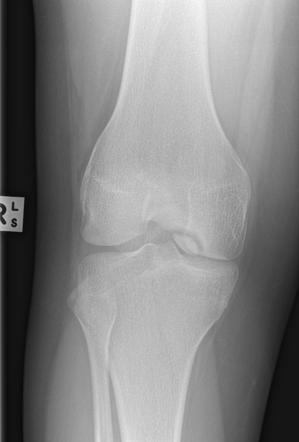 Osteochondral defect | Radiology Case | Radiopaedia.org